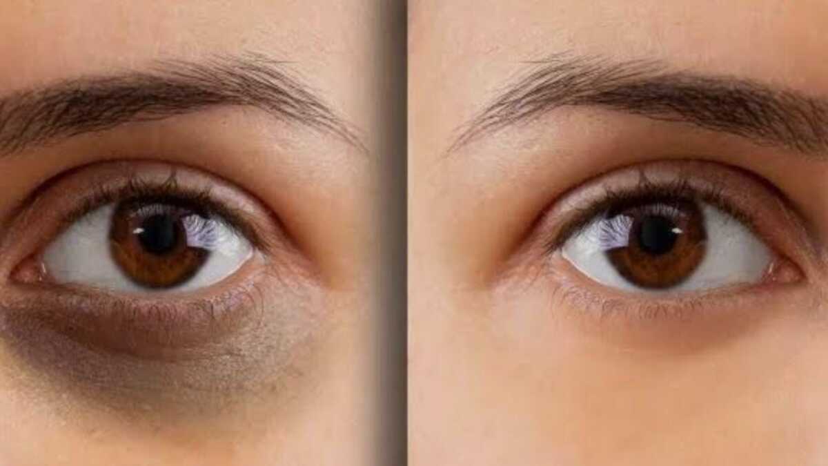 Dark Circles
