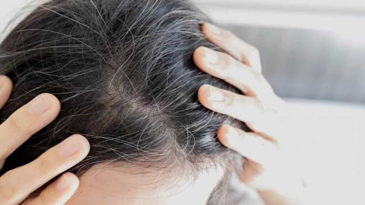 White Hair Remedies