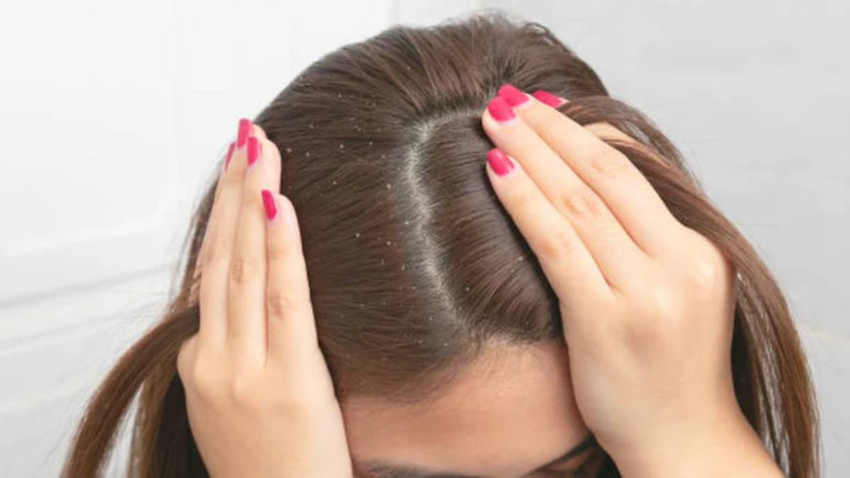 Dandruff Treatment