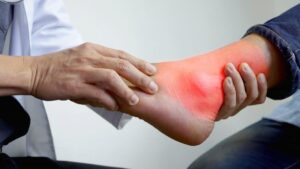 Uric Acid Natural Remedies