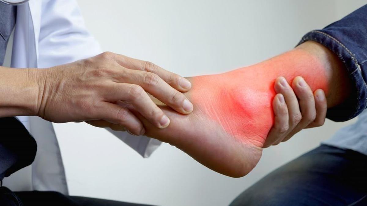 Uric Acid Natural Remedies