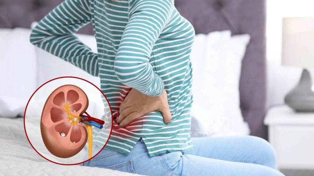 Kidney Stone Symptoms